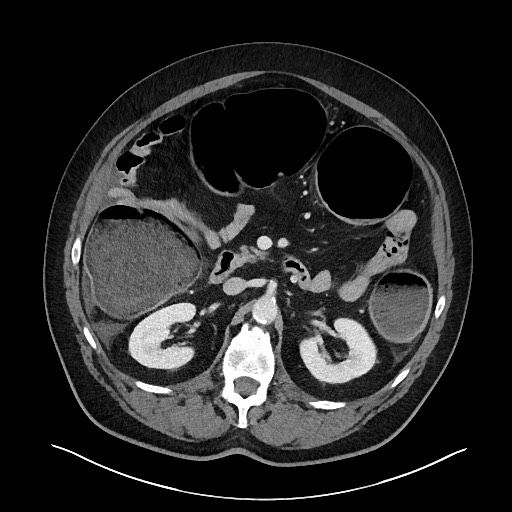 Obstructing sigmoid adenocarcinoma (Radiopaedia 58465-65619 A 63).jpg