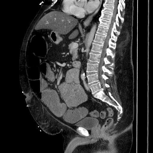 Obstructive colonic diverticular stricture (Radiopaedia 81085-94675 C 125).jpg
