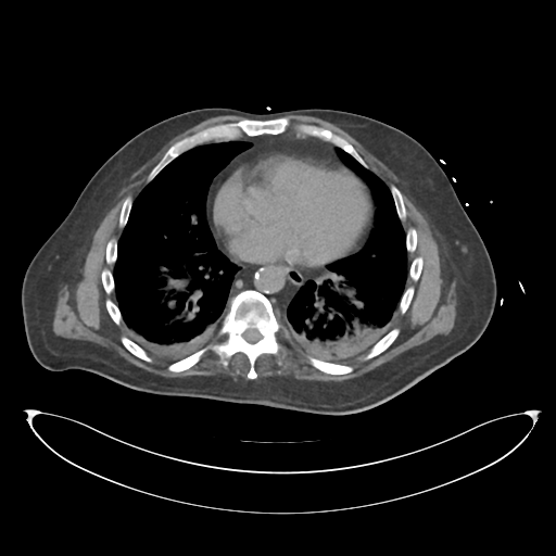 File:Obstructive pyelonephritis (Radiopaedia 46411-50844 Axial non-contrast 5).png