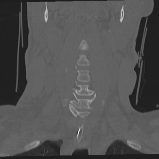 File:Occipital condyle fracture (Radiopaedia 33467-34517 Coronal bone window 19).png