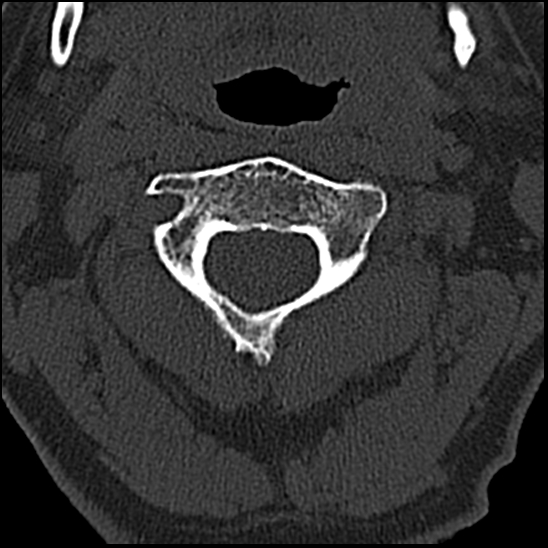 Occipital condyle fracture (type 1) (Radiopaedia 87670-104084 Axial bone window 28).jpg