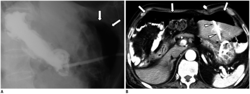 a.b)Pneumoperitoneum developed three days following percutaneous radiologic gastrostomy