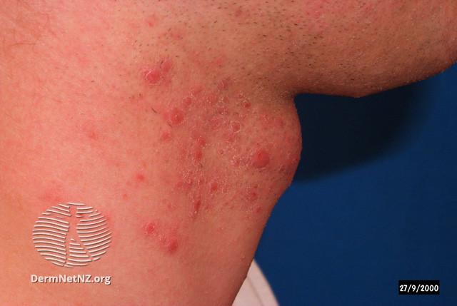 File:(DermNet NZ acne-folliculitis-2654).jpg