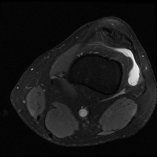File:ACL and meniscal tears (Radiopaedia 79604-92797 Axial PD fat sat 4).jpg