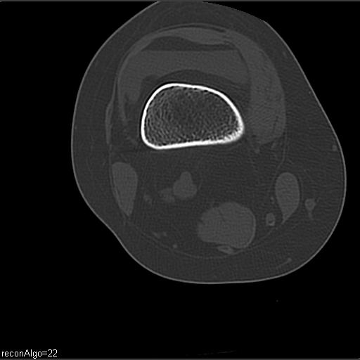 File:ACL avulsion fracture (Radiopaedia 33833-34994 Axial bone window 8).jpg
