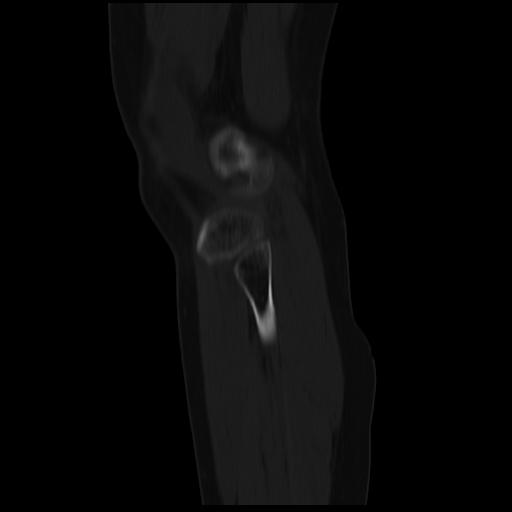 File:ACL avulsion fracture (Radiopaedia 33833-34994 Sagittal bone window 7).jpg
