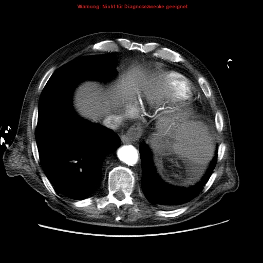 Abdominal aortic aneurysm- extremely large, ruptured (Radiopaedia 19882-19921 Axial C+ arterial phase 6).jpg