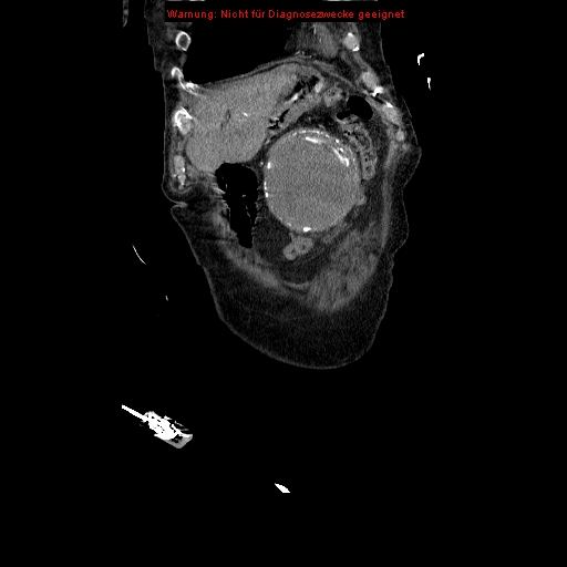 Abdominal aortic aneurysm- extremely large, ruptured (Radiopaedia 19882-19921 Coronal C+ arterial phase 17).jpg