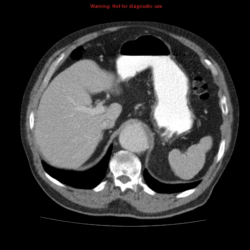 File:Abdominal aortic aneurysm (Radiopaedia 10122-10660 Axial C+ portal venous phase 17).jpg