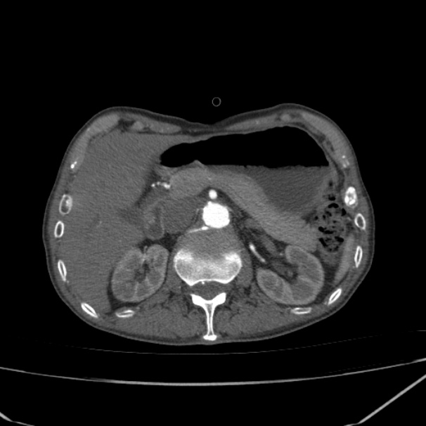 Abdominal aortic aneurysm (Radiopaedia 23703-23856 Axial C+ arterial phase 20).jpg