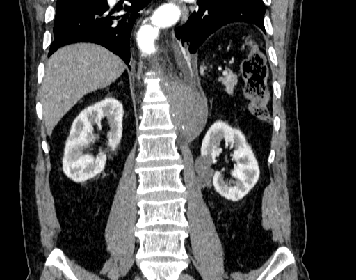 Abdominal aortic aneurysm (Radiopaedia 67117-76452 Coronal C+ arterial phase 69).jpg