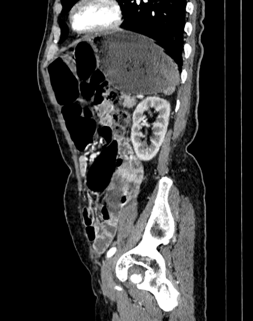 Abdominal aortic aneurysm (Radiopaedia 83581-98689 Sagittal C+ arterial phase 91).jpg