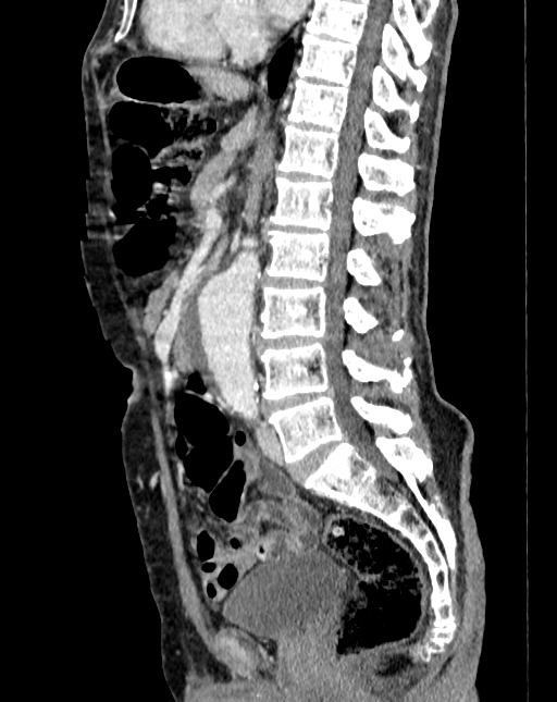 Abdominal aortic aneurysm (Radiopaedia 83581-98689 Sagittal C+ portal venous phase 50).jpg