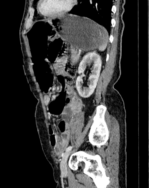 Abdominal aortic aneurysm (Radiopaedia 83581-98689 Sagittal C+ portal venous phase 96).jpg