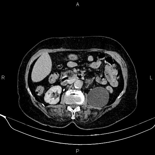 Abdominal aortic aneurysm (Radiopaedia 85063-100606 Axial C+ delayed 44).jpg