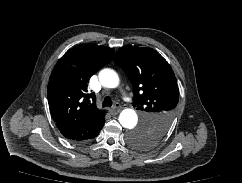 Abdominal aortic aneurysm rupture (Radiopaedia 54179-60362 Axial C+ arterial phase 7).jpg