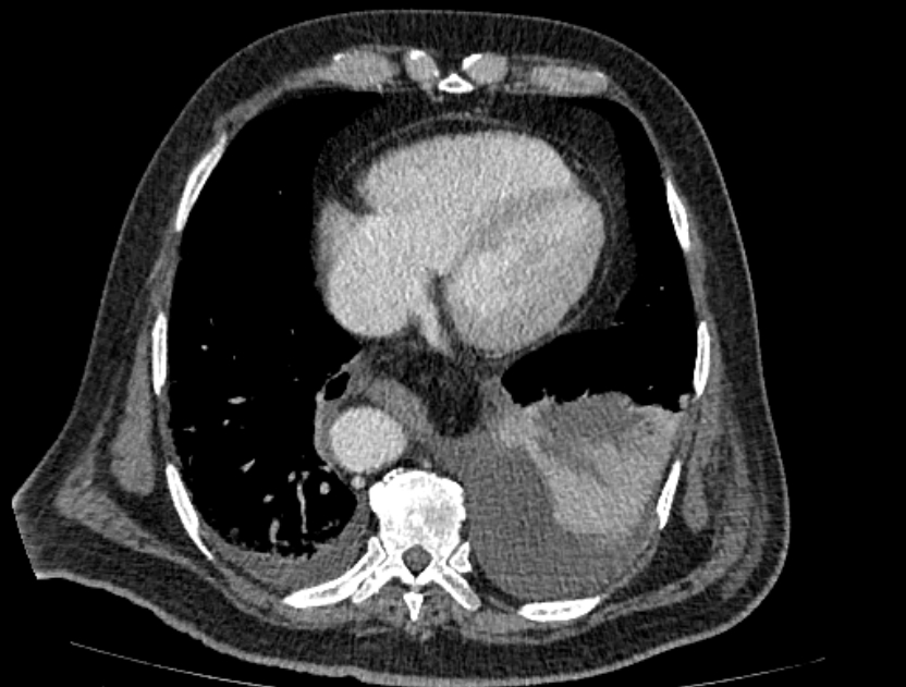 Abdominal aortic aneurysm rupture (Radiopaedia 54179-60362 Axial C+ portal venous phase 37).jpg