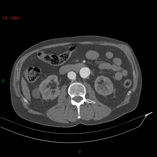 Abdominal aortic aneurysm rupture with aortocaval fistula (Radiopaedia 14897-14841 Axial C+ arterial phase 109).jpg