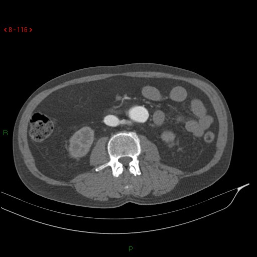 File:Abdominal aortic aneurysm rupture with aortocaval fistula (Radiopaedia 14897-14841 Axial C+ arterial phase 116).jpg