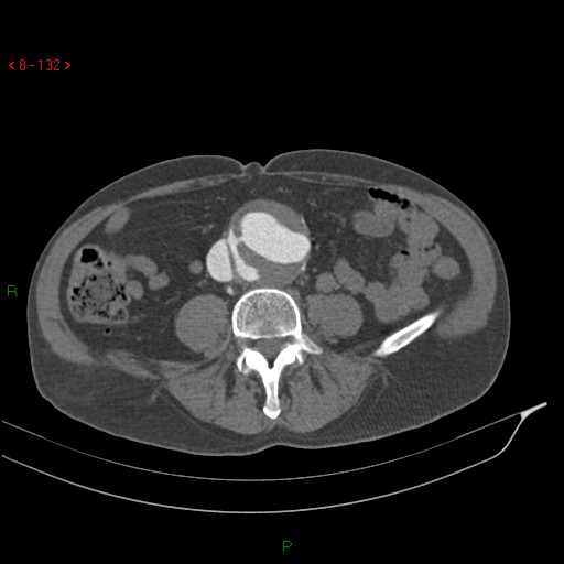 File:Abdominal aortic aneurysm rupture with aortocaval fistula (Radiopaedia 14897-14841 Axial C+ arterial phase 132).jpg