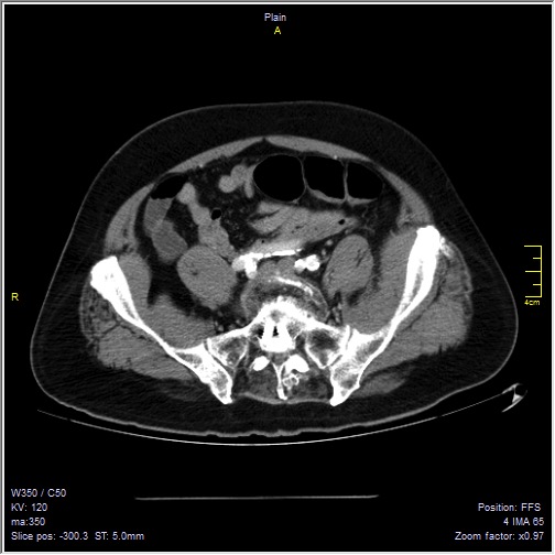 Abdominal aortic aneurysm with thrombus fissuration (Radiopaedia 47340-51926 Axial C+ arterial phase 49).jpg