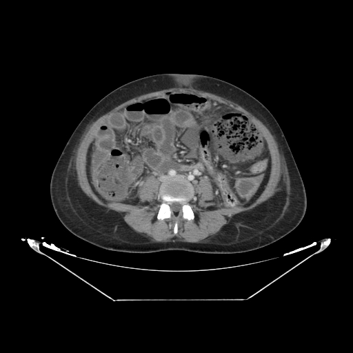 Abdominal gossypiboma- surgical towel (Radiopaedia 57288-64226 Axial C+ portal venous phase 44).jpg