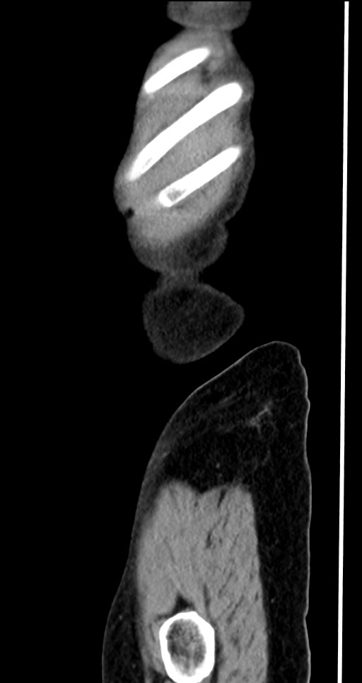 Abdominal wall and retroperitoneal tuberculosis (Radiopaedia 88137-104729 Sagittal C+ portal venous phase 13).jpg