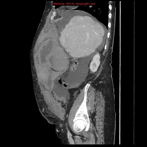 Abdominal wall hematoma (Radiopaedia 9427-10112 Sagittal C+ portal venous phase 80).jpg