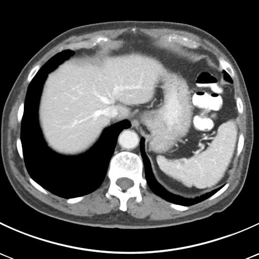Abdominal wall metastasis from colorectal carcinoma (Radiopaedia 31016-31717 Axial C+ portal venous phase 15).jpg