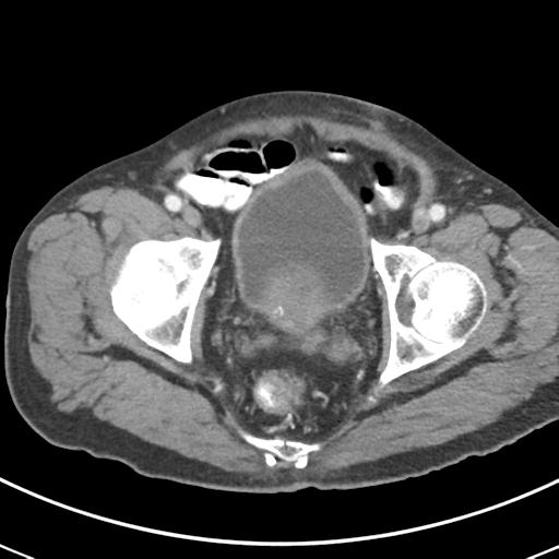 Abdominal wall metastasis from colorectal carcinoma (Radiopaedia 31016-31717 Axial C+ portal venous phase 70).jpg