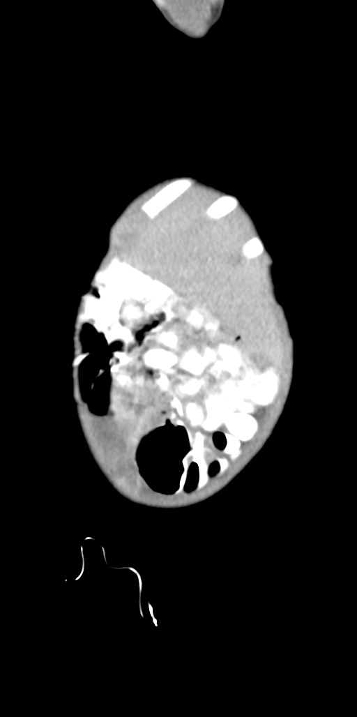 Abdominopelvic rhabdomyosarcoma (Radiopaedia 78356-90984 Sagittal C+ portal venous phase 92).jpg