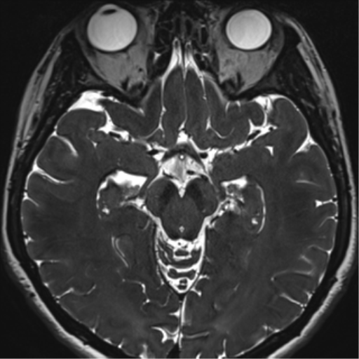 Abducens nerve palsy (Radiopaedia 51069-56648 Axial T2 fat sat 68).png