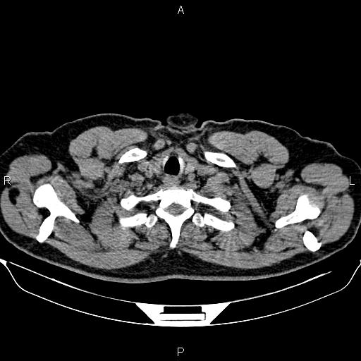 Aberrant right subclavian artery (Radiopaedia 87093-103354 Axial non-contrast 5).jpg