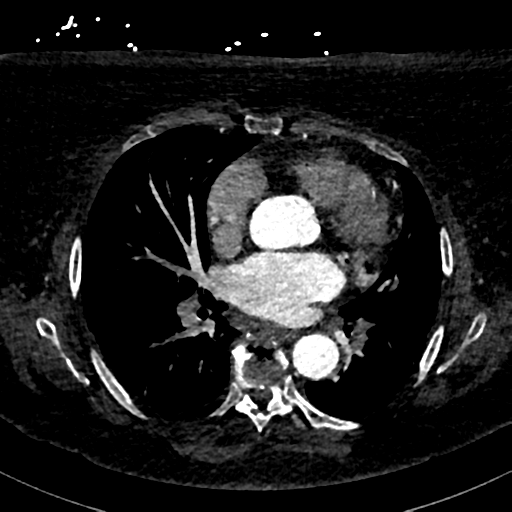 Aberrant right subclavian artery with Kommerell diverticulum (Radiopaedia 47982-52769 Axial C+ arterial phase 51).png