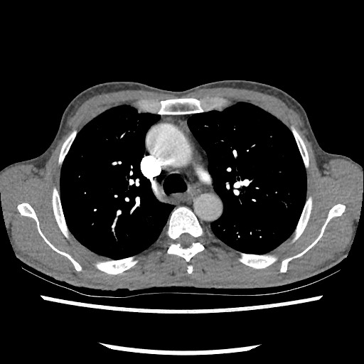 File:Accessory left horizontal fissure with lingular pneumonia (Radiopaedia 53763-59843 Axial C+ CTPA 35).jpg
