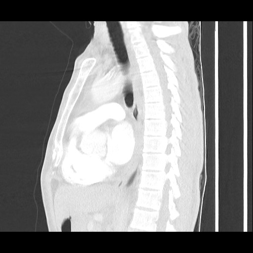 Accessory left horizontal fissure with lingular pneumonia (Radiopaedia 53763-59843 Sagittal lung window 36).jpg