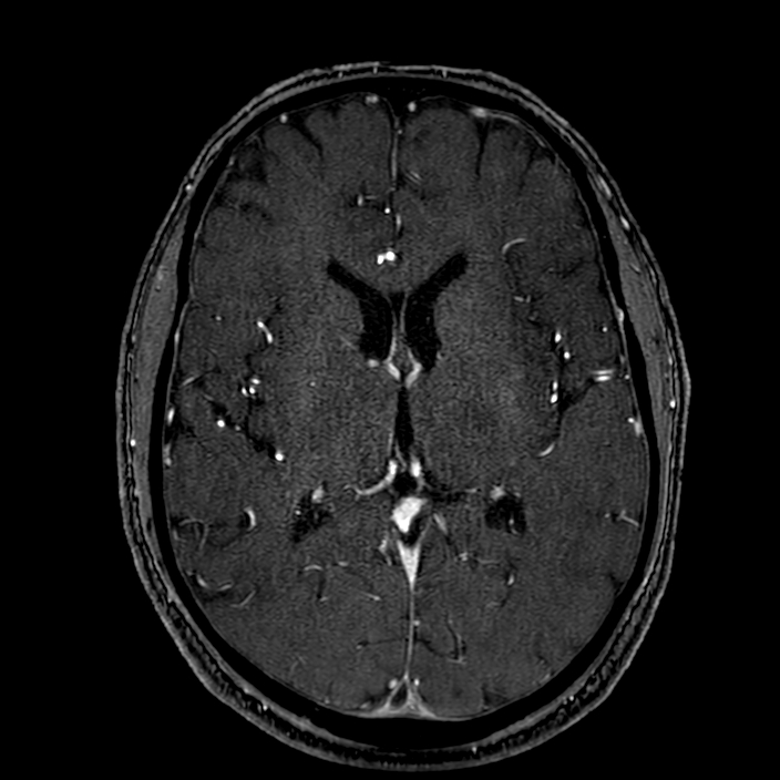 Accessory middle cerebral artery (Radiopaedia 73114-83828 Axial MRA 111).jpg