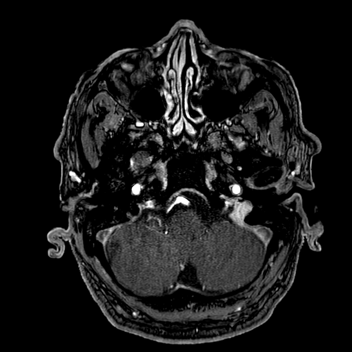 Accessory middle cerebral artery (Radiopaedia 73114-83828 Axial MRA 22).jpg