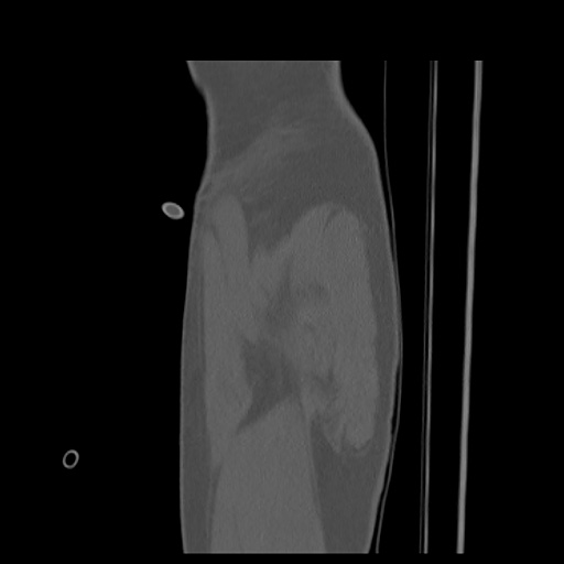 File:Acetabular and ilial fractures (Radiopaedia 59084-66378 Sagittal bone window 3).jpg