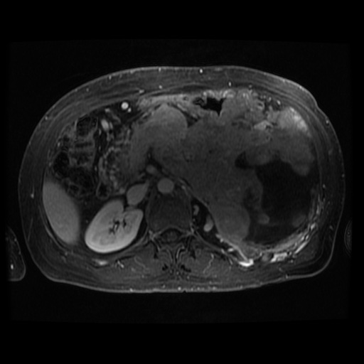 File:Acinar cell carcinoma of the pancreas (Radiopaedia 75442-86668 Axial 254).jpg