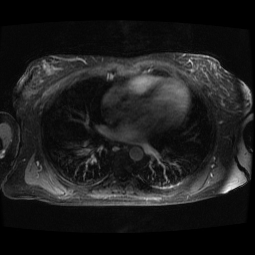 Acinar cell carcinoma of the pancreas (Radiopaedia 75442-86668 D 151).jpg