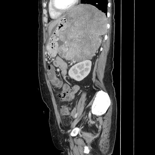 File:Acinar cell carcinoma of the pancreas (Radiopaedia 75442-86669 Sagittal C+ portal venous phase 129).jpg