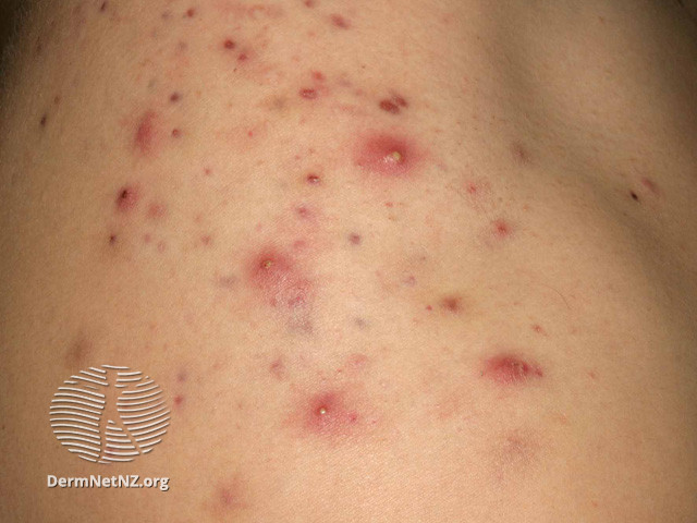 File:Acne affecting the back images (DermNet NZ acne-acne-back-195).jpg