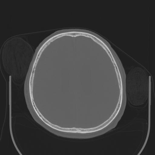 File:Acoustic schwannoma (Radiopaedia 29488-29982 AXIAL BONE THICK non-contrast 34).jpg