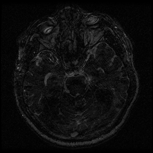 Acoustic schwannoma (Radiopaedia 33045-34060 Axial T2 71).png