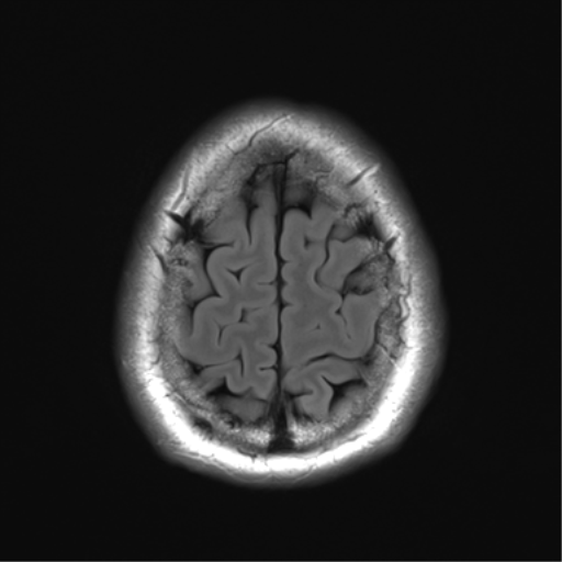 File:Acoustic schwannoma (Radiopaedia 50846-56358 Axial FLAIR 28).png