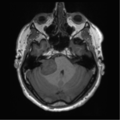 File:Acoustic schwannoma (Radiopaedia 50846-56358 Axial T1 23).png
