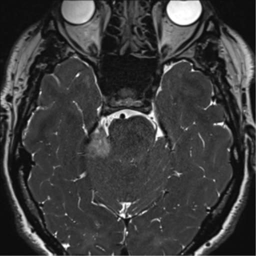 File:Acoustic schwannoma (Radiopaedia 50846-56358 Axial T2 31).png