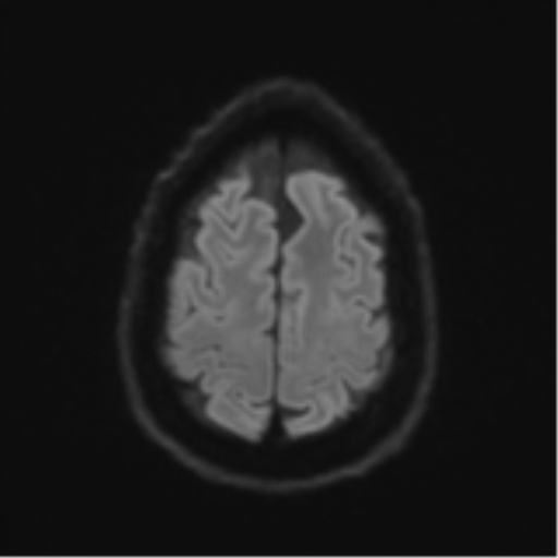 Acoustic schwannoma (Radiopaedia 55729-62281 E 51).png
