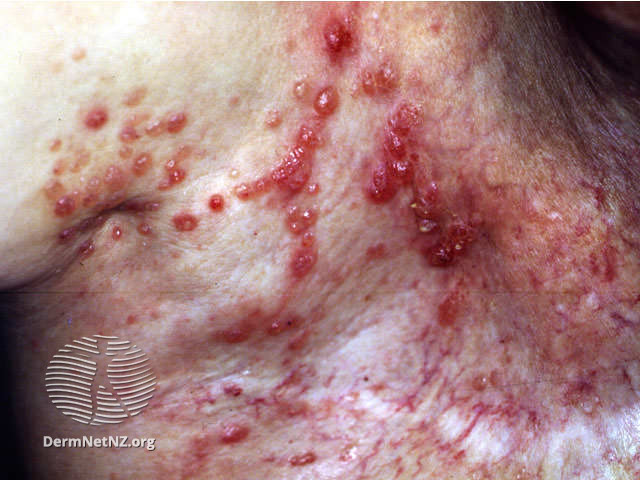 File:Acquired lymphangiectasia (DermNet NZ doctors-lesions-images-lymphangiectasia1).jpg